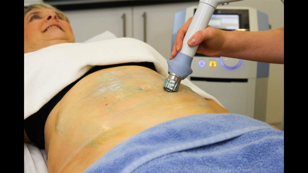 Model getting laser treatment on stomach