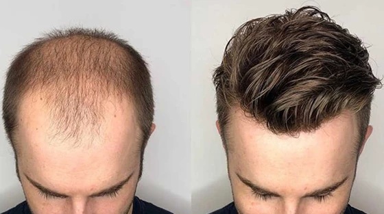 Super hair pieces